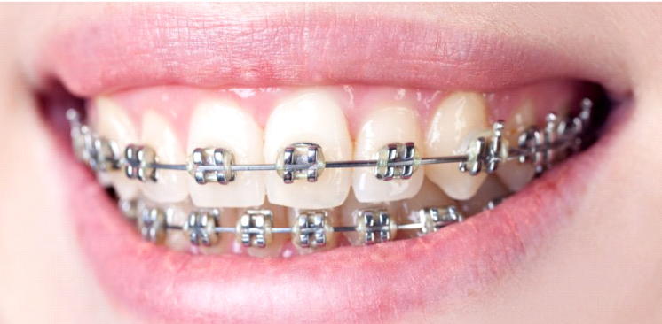 Braces & Aligners | Orange Dental Clinic