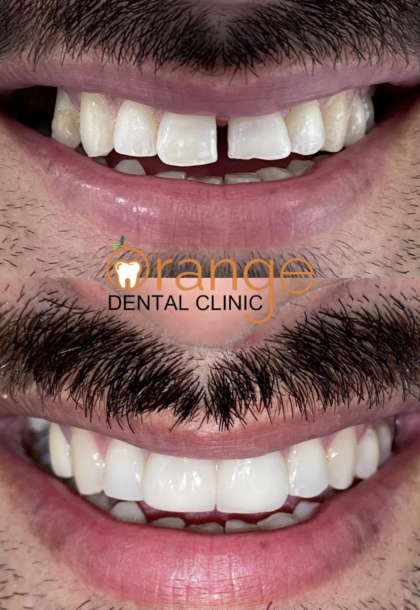 Smile Designing with Digital Dentistry in Chandigarh — Transform Your Smile with Precision