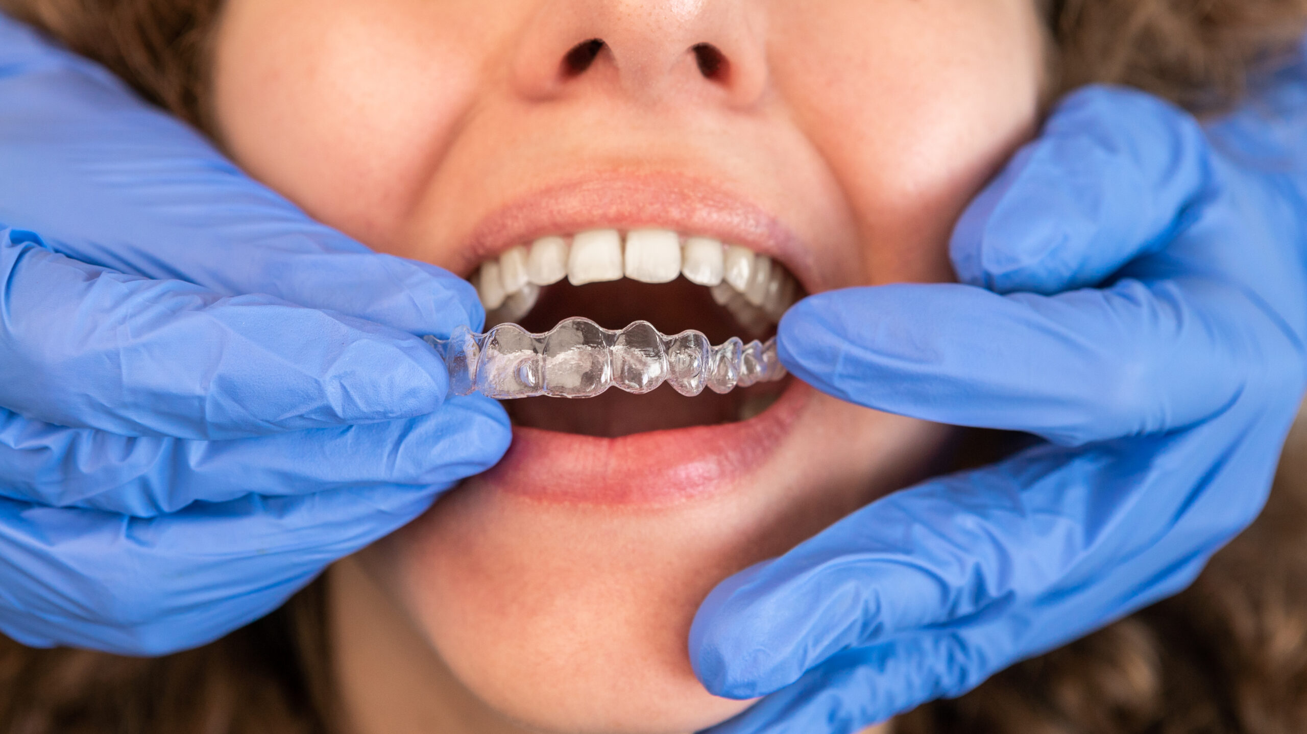 applying invisaligners