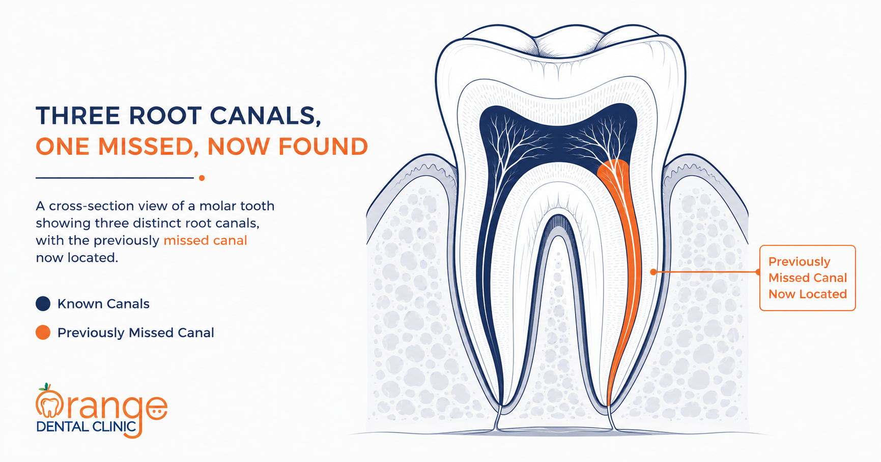 Root Canal Retreatment: When Is It Needed?