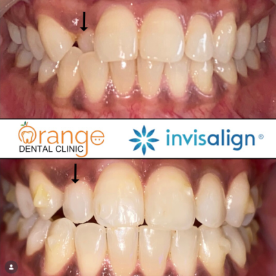 Invisalign