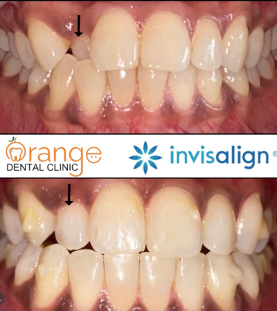 Invisalign