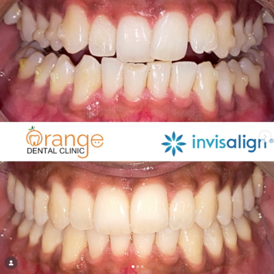 Invisalign2