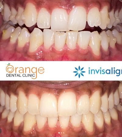 Invisalign2