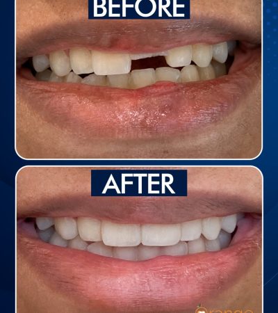 Broken teeth front before after