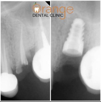 dental implant xray dental implant xray