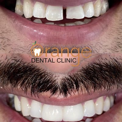 dentel veneer before after