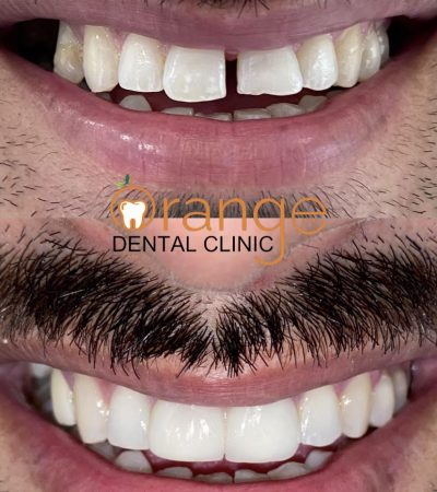 dentel veneer before after