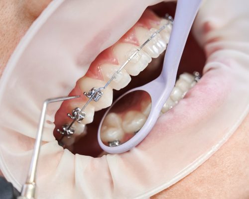 dentist-attaching-metal-braces-patient-teeth-min (1)