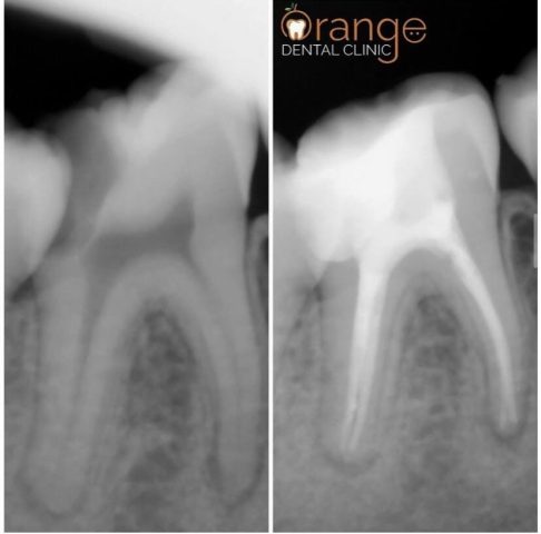 root canal 1 root canal 1