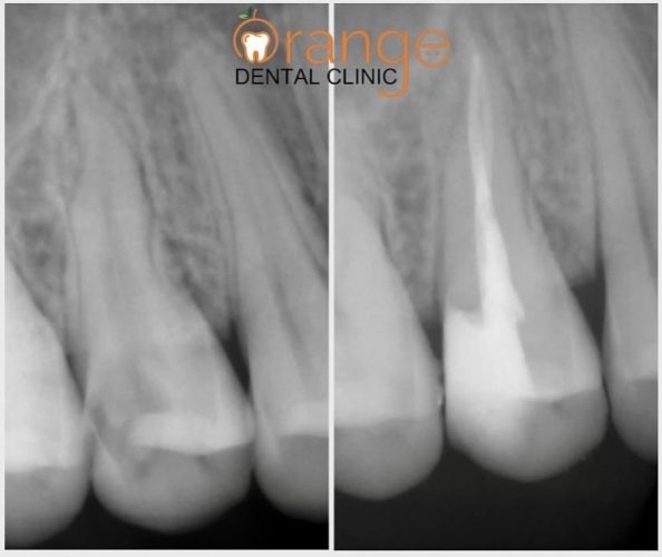 root canal 2 root canal 2